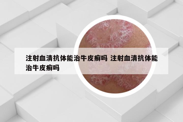 注射血清抗体能治牛皮癣吗 注射血清抗体能治牛皮癣吗