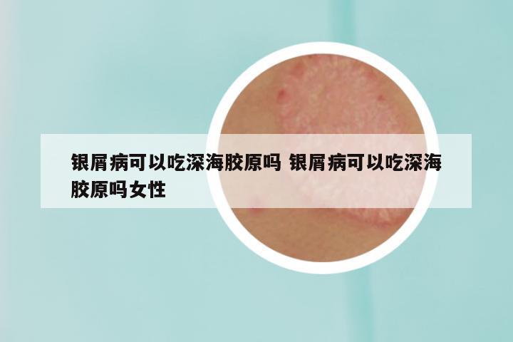 银屑病可以吃深海胶原吗 银屑病可以吃深海胶原吗女性