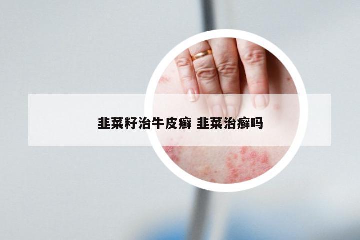 韭菜籽治牛皮癣 韭菜治癣吗