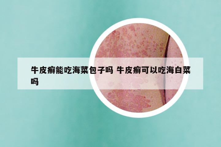 牛皮癣能吃海菜包子吗 牛皮癣可以吃海白菜吗