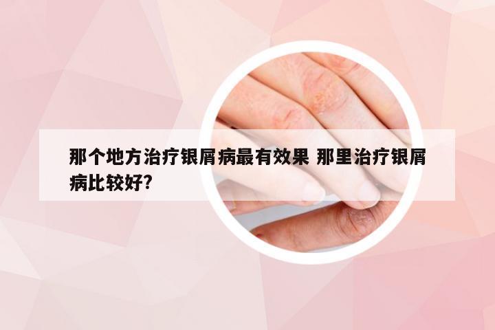 那个地方治疗银屑病最有效果 那里治疗银屑病比较好?