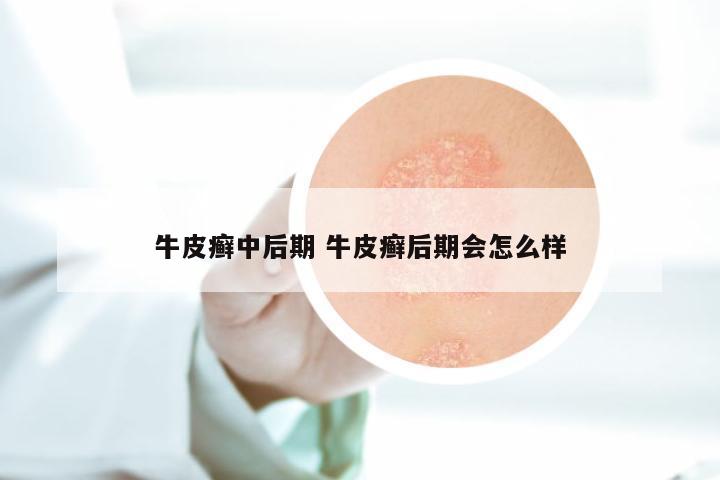 牛皮癣中后期 牛皮癣后期会怎么样