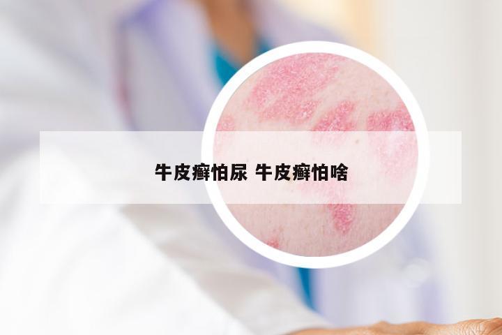 牛皮癣怕尿 牛皮癣怕啥