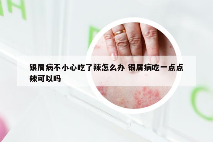 银屑病不小心吃了辣怎么办 银屑病吃一点点辣可以吗