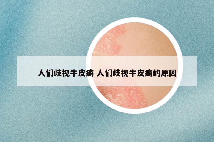 人们歧视牛皮癣 人们歧视牛皮癣的原因
