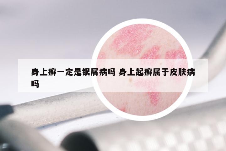 身上癣一定是银屑病吗 身上起癣属于皮肤病吗