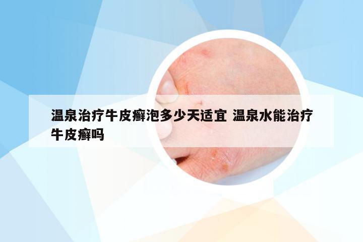 温泉治疗牛皮癣泡多少天适宜 温泉水能治疗牛皮癣吗