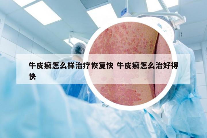 牛皮癣怎么样治疗恢复快 牛皮癣怎么治好得快