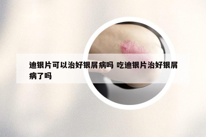 迪银片可以治好银屑病吗 吃迪银片治好银屑病了吗