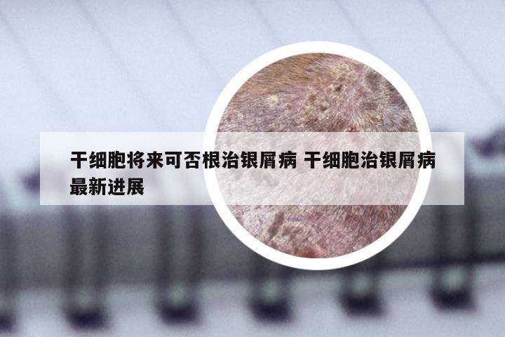 干细胞将来可否根治银屑病 干细胞治银屑病最新进展