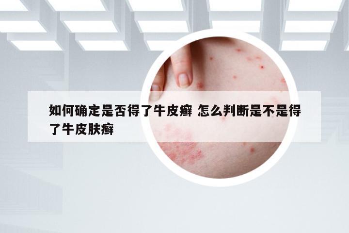 如何确定是否得了牛皮癣 怎么判断是不是得了牛皮肤癣