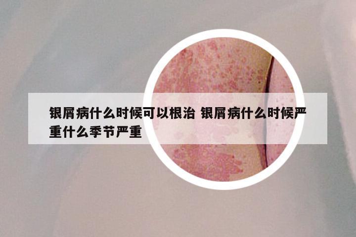 银屑病什么时候可以根治 银屑病什么时候严重什么季节严重