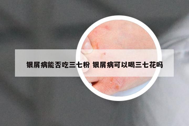 银屑病能否吃三七粉 银屑病可以喝三七花吗