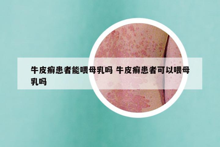 牛皮癣患者能喂母乳吗 牛皮癣患者可以喂母乳吗