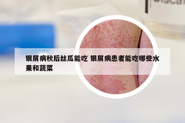 银屑病秋后丝瓜能吃 银屑病患者能吃哪些水果和蔬菜