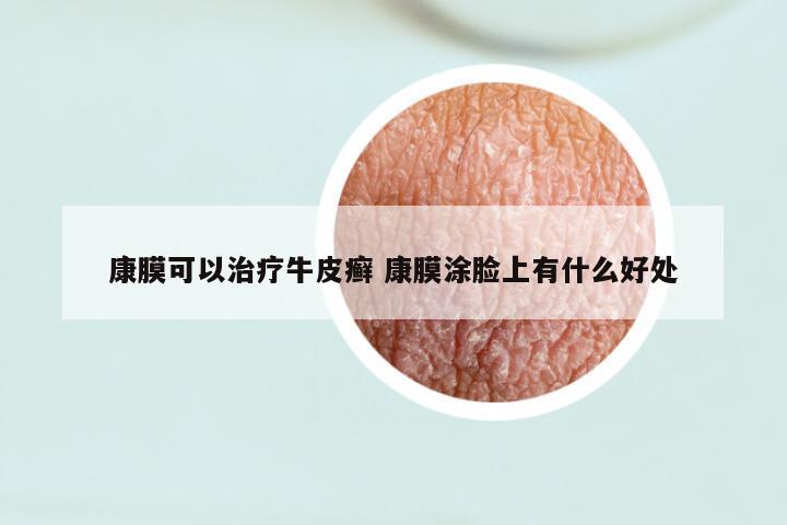 康膜可以治疗牛皮癣 康膜涂脸上有什么好处