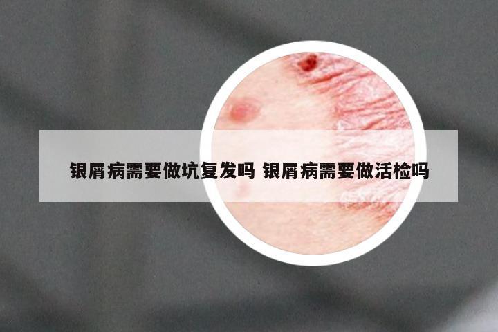 银屑病需要做坑复发吗 银屑病需要做活检吗