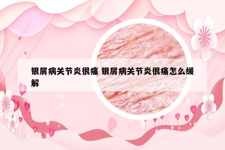 银屑病关节炎很痛 银屑病关节炎很痛怎么缓解