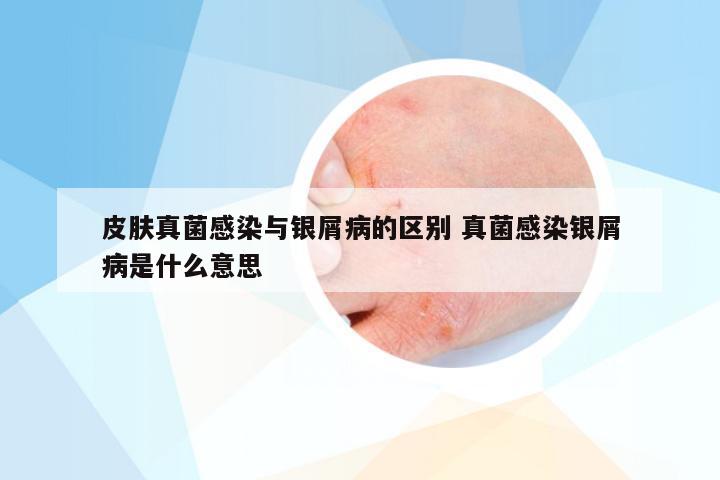 皮肤真菌感染与银屑病的区别 真菌感染银屑病是什么意思