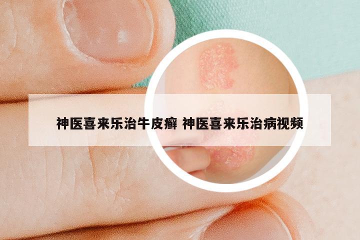 神医喜来乐治牛皮癣 神医喜来乐治病视频