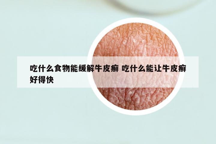 吃什么食物能缓解牛皮癣 吃什么能让牛皮癣好得快