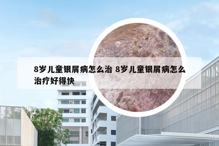 8岁儿童银屑病怎么治 8岁儿童银屑病怎么治疗好得快