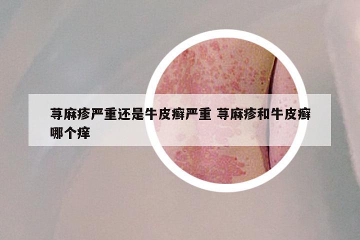 荨麻疹严重还是牛皮癣严重 荨麻疹和牛皮癣哪个痒