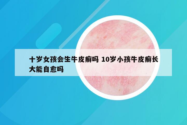 十岁女孩会生牛皮癣吗 10岁小孩牛皮癣长大能自愈吗