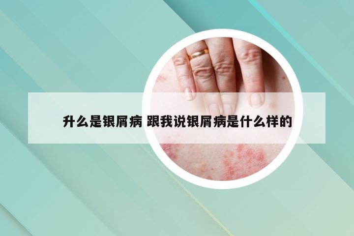 升么是银屑病 跟我说银屑病是什么样的