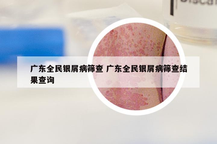 广东全民银屑病筛查 广东全民银屑病筛查结果查询