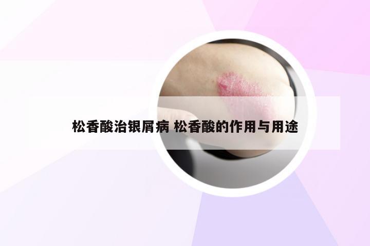 松香酸治银屑病 松香酸的作用与用途