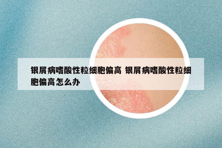 银屑病嗜酸性粒细胞偏高 银屑病嗜酸性粒细胞偏高怎么办