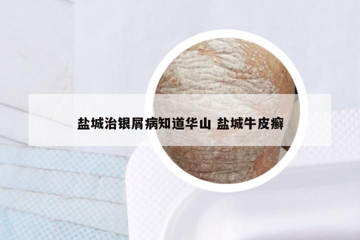 盐城治银屑病知道华山 盐城牛皮癣