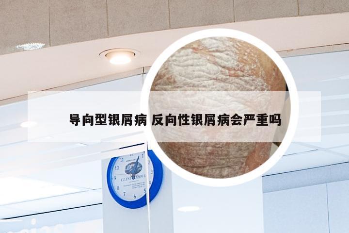 导向型银屑病 反向性银屑病会严重吗