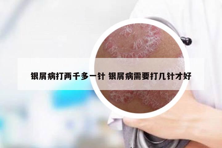 银屑病打两千多一针 银屑病需要打几针才好