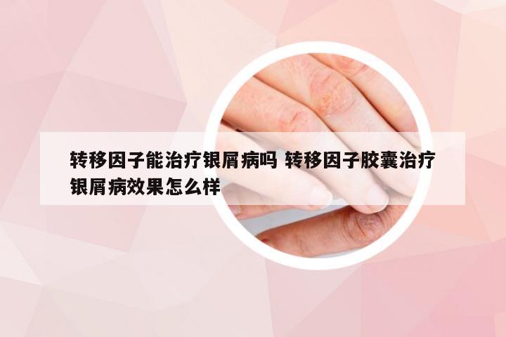 转移因子能治疗银屑病吗 转移因子胶囊治疗银屑病效果怎么样