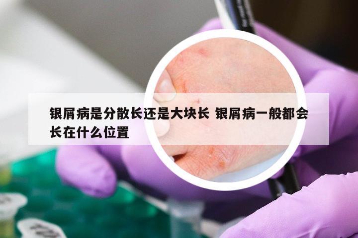 银屑病是分散长还是大块长 银屑病一般都会长在什么位置