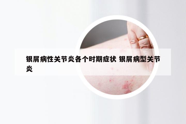 银屑病性关节炎各个时期症状 银屑病型关节炎