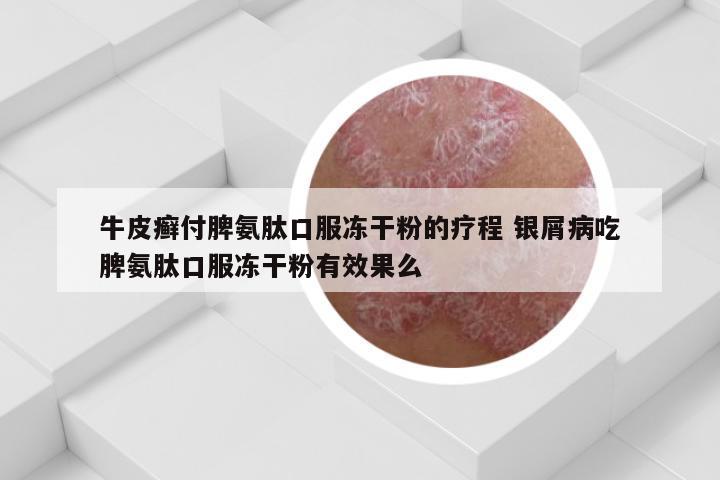 牛皮癣付脾氨肽口服冻干粉的疗程 银屑病吃脾氨肽口服冻干粉有效果么