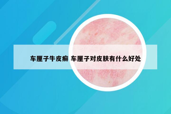 车厘子牛皮癣 车厘子对皮肤有什么好处