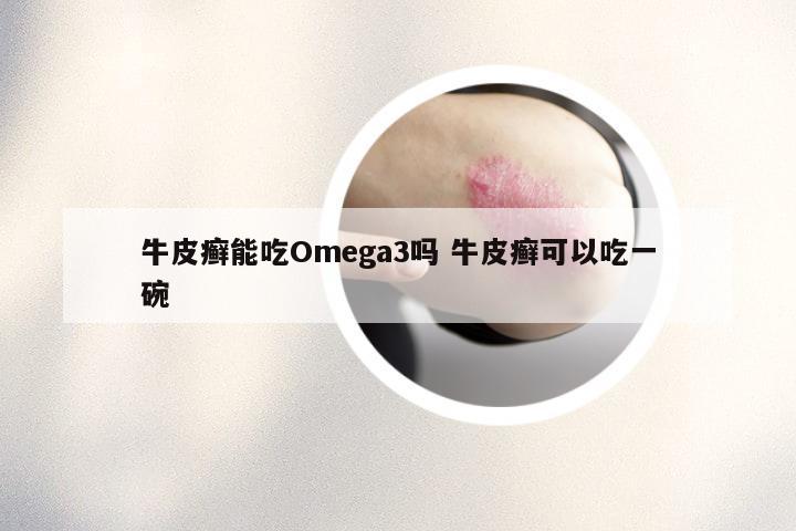 牛皮癣能吃Omega3吗 牛皮癣可以吃一碗