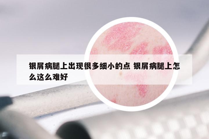银屑病腿上出现很多细小的点 银屑病腿上怎么这么难好