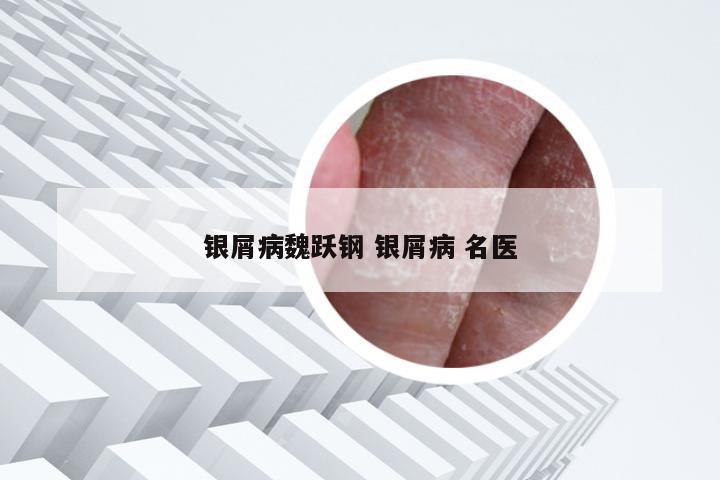 银屑病魏跃钢 银屑病 名医