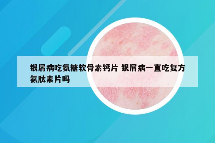 银屑病吃氨糖软骨素钙片 银屑病一直吃复方氨肽素片吗