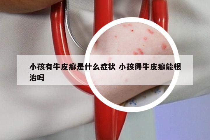 小孩有牛皮癣是什么症状 小孩得牛皮癣能根治吗