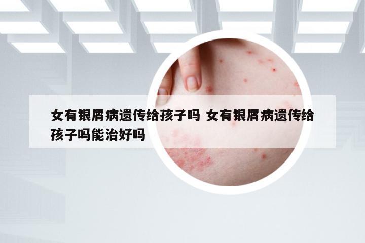 女有银屑病遗传给孩子吗 女有银屑病遗传给孩子吗能治好吗