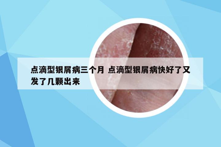 点滴型银屑病三个月 点滴型银屑病快好了又发了几颗出来