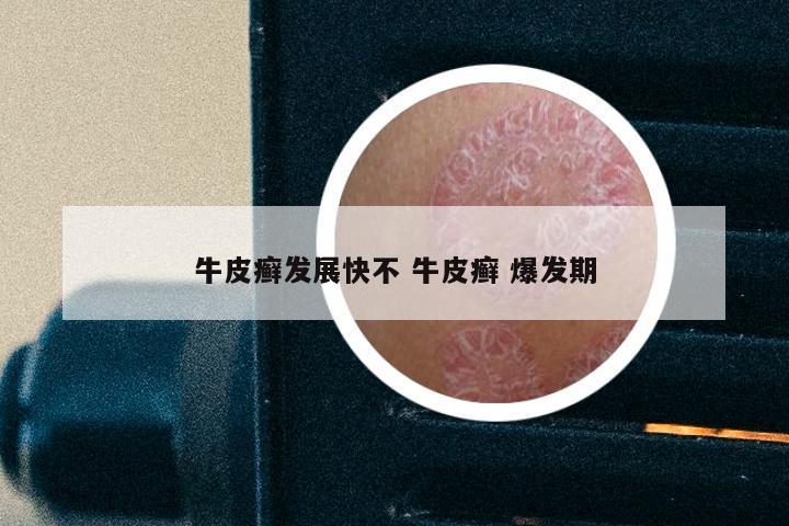牛皮癣发展快不 牛皮癣 爆发期