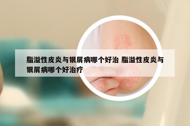 脂溢性皮炎与银屑病哪个好治 脂溢性皮炎与银屑病哪个好治疗