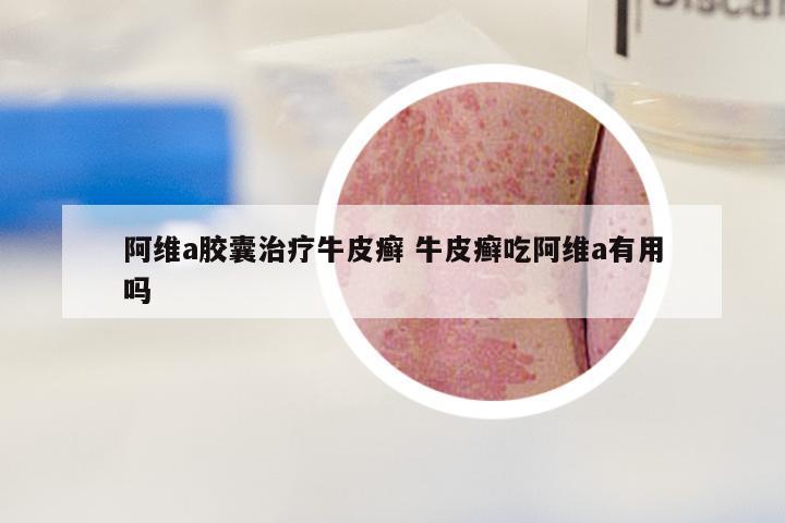 阿维a胶囊治疗牛皮癣 牛皮癣吃阿维a有用吗